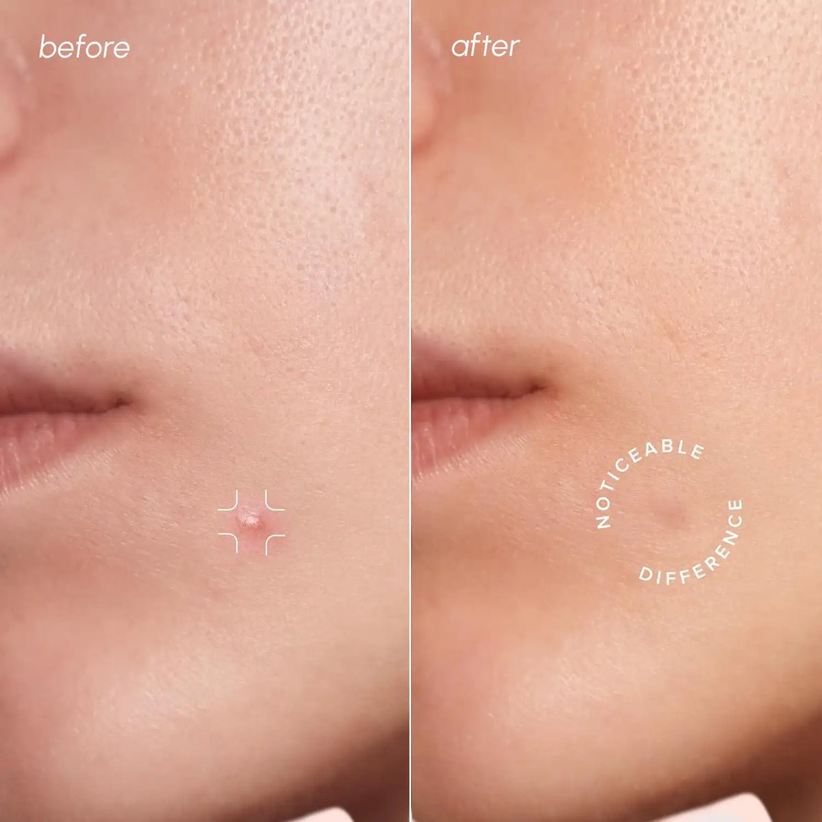 Invisible Pimple & Acne Patches by Maree — product image 2